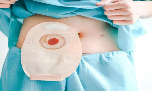 young-caucasian-patient-blue-disposable-medical-pajamas-shows-with-his-hands-colostomy-bag-his-stomach