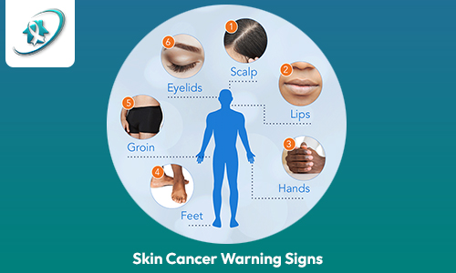 skin-cancer-signs-detect-moles-early